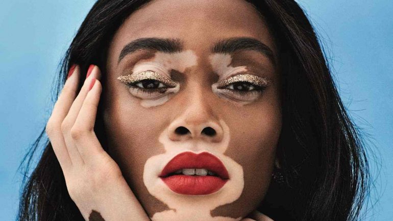 Winnie Harlow – Altezza – Peso – Misure – Colore occhio – Wiki